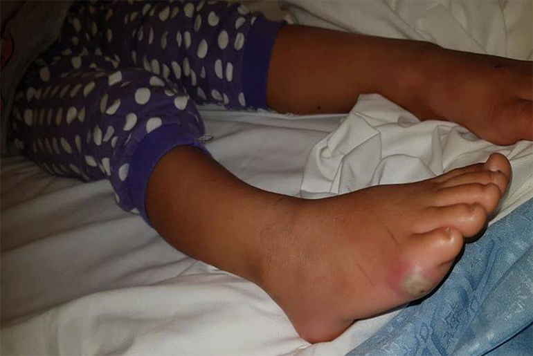 كندا : إصابة طفلة ببكتيريا قاتلة بعد تجربتها لحذاء جديد